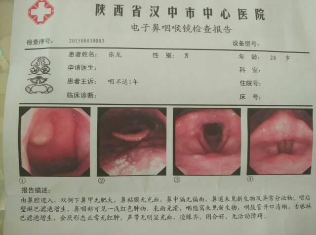 鼻咽囊肿手术多少钱