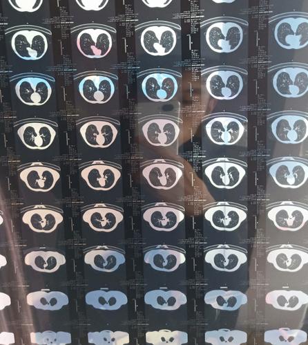 今天体检说我肺部有阴影做了个ct单子写的是什么意思看不懂