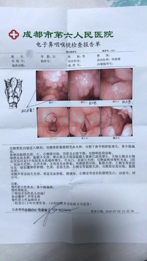 咽喉囊肿,多发性乳头肿瘤