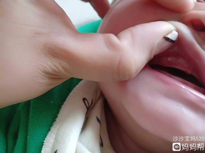 五个月宝宝牙龈起这个白疙瘩是什么急急急
