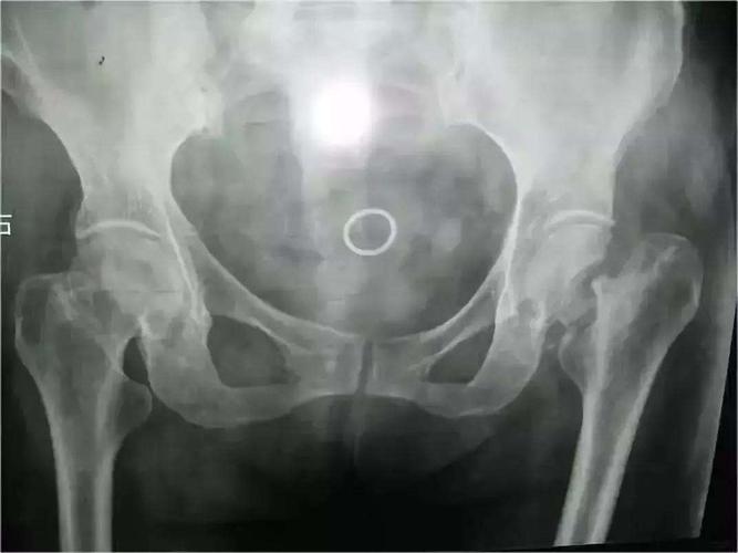 人生最后一次骨折:股骨颈骨折