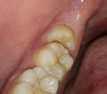 我的智齿好想长歪了,要不要拔