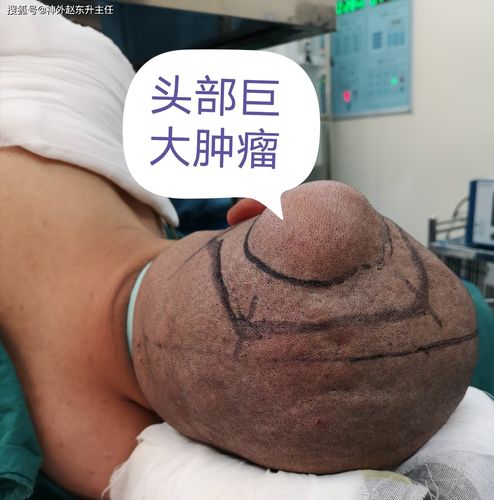 原创头部一个小疙瘩快速长大,一定要当心有可能是恶性转移瘤