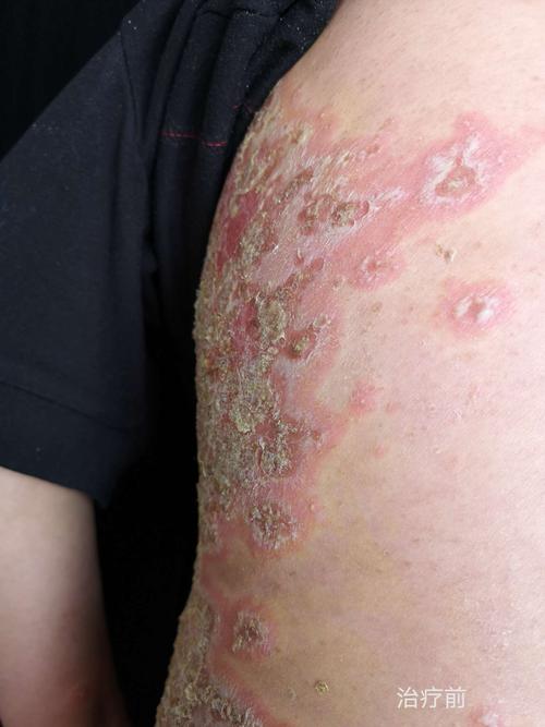 司库奇尤单抗治疗脓疱型银屑病