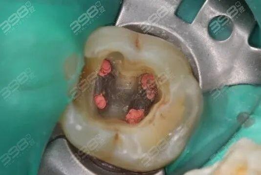 根管治疗做牙套骗局?那是你不知道根管治疗后牙齿的寿命