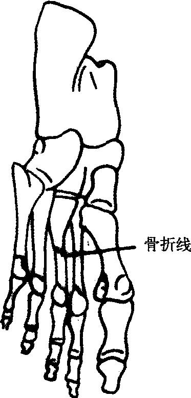第十三节跖骨骨折
