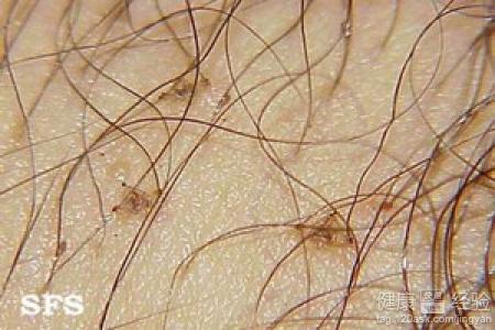 阴虱的最佳治疗