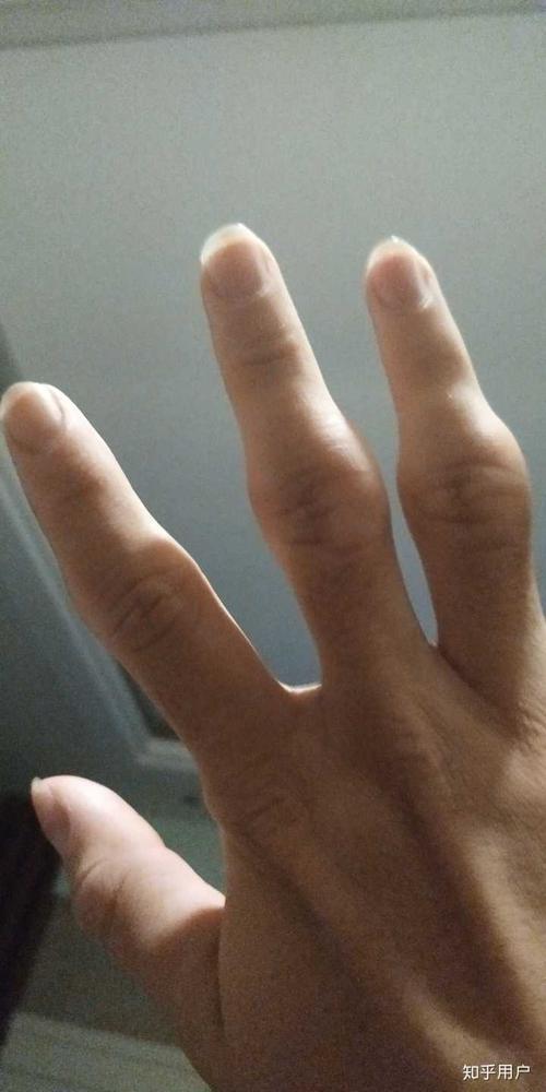 手指骨节大怎么办.好像是当初不懂事按响造成的(虽然很爽……)?