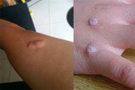 鱼痣如何简单去掉 4个妙招帮你解决问题