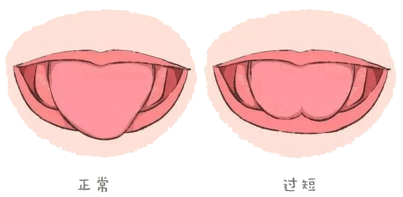 看看宝宝舌系带是否过短