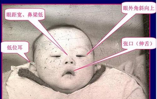 唐氏综合征有哪些特征?