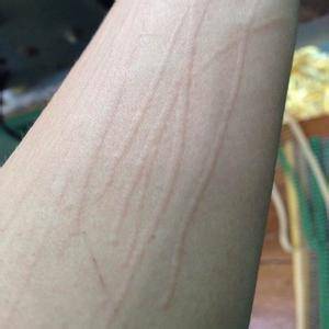 武汉太医堂解答皮肤一划现红肿是不是人工性荨麻疹?