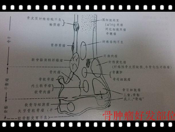 骨肿瘤好发部位图解