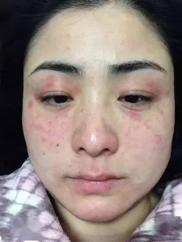 什么是油敏?什么是激素敏?