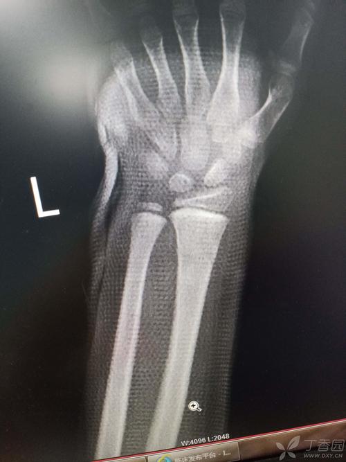 儿童桡骨远端骨折,欢迎大家交流经验.