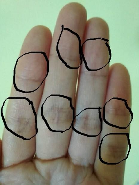 手指上血管鼓起,疼,触碰或用力提物更疼