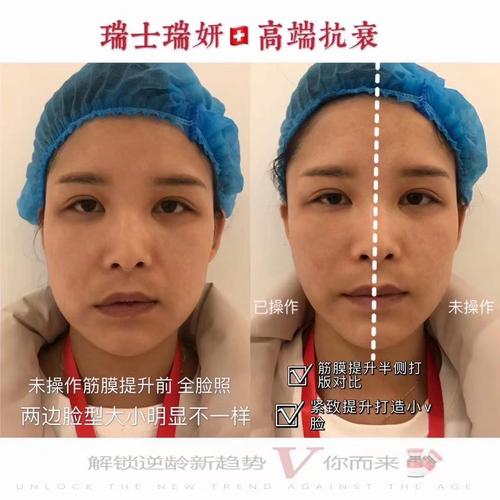 瑞士瑞妍筋膜再植提升半边效果对比