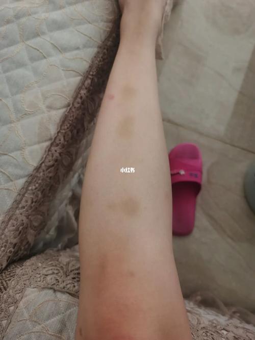 夏天腿上淤青的原因_夏天去哪玩_中医_维生素_蔬菜