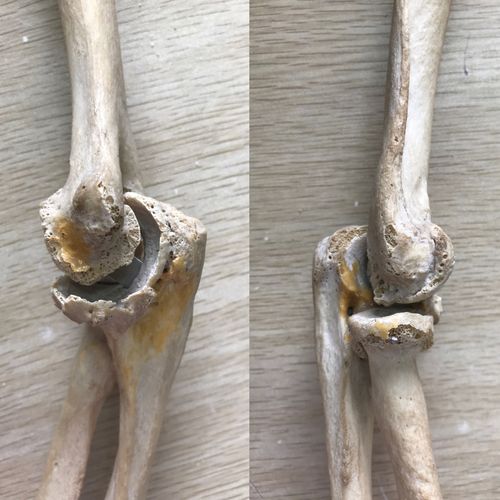 怎样才能做好尺骨鹰嘴骨折的张力带固定?