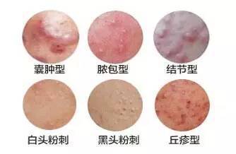 性痤疮:痤疮的症状表现为大小不等的皮脂腺囊肿内含有带血的粘稠脓液