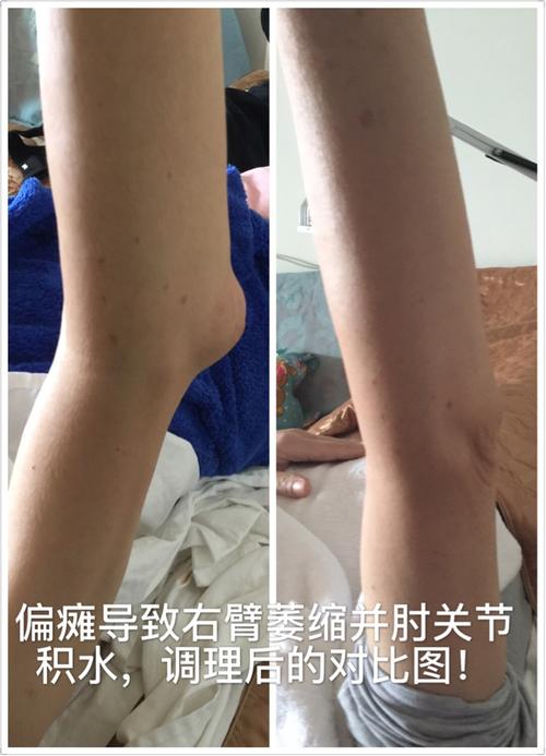 中医调理让肌肉萎缩和手肘积水患者康复!
