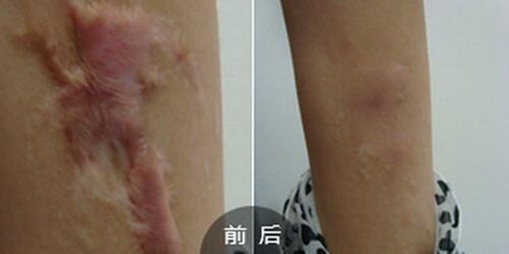 伤口深手术后增生性疤痕图片