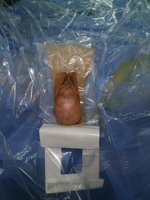 子宫脱垂的微创治疗