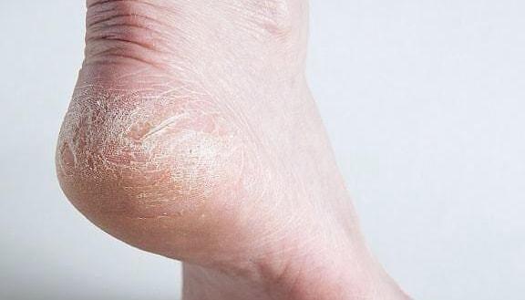 脚后跟干裂小腿长鱼鳞真相不是皮肤缺水而是因为