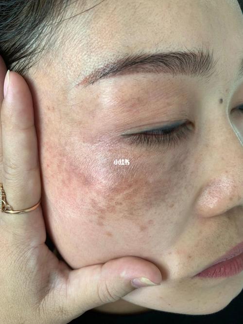 真皮斑的治疗过程_美白祛斑_美妆_护肤