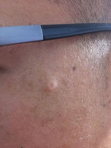 脸上像粉刺一样的,请问是啥,上图?