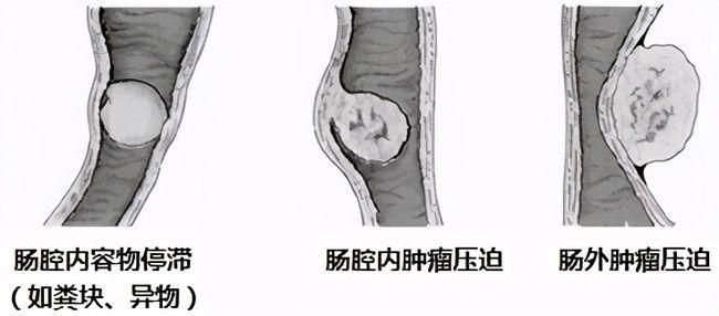 腹部阵发性绞痛,警惕肠梗阻!