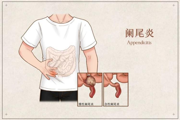 急性阑尾炎说来就来,还不是因为这3大因素,说不定要开刀.