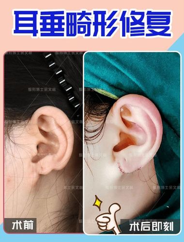 耳垂裂可以直接缝合吗耳垂修复术前需要做哪些准备