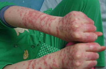 蝴蝶形红斑狼疮的症状