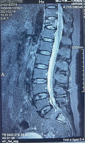 64岁胸椎压缩性骨折患者椎体成形手术一例