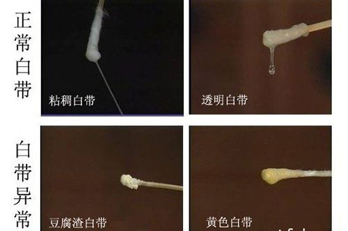 还可见于慢性宫颈炎,老年性阴道炎,子宫内膜炎,宫腔积液或阴道内异物