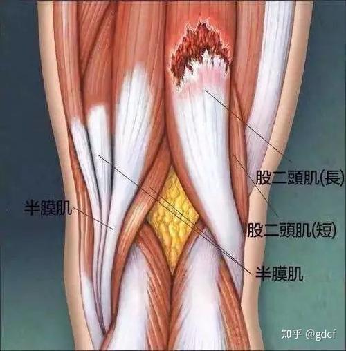 什么是肌肉拉伤?