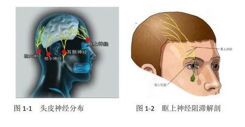 眶上神经阻滞头皮神经分布见(图1-1).