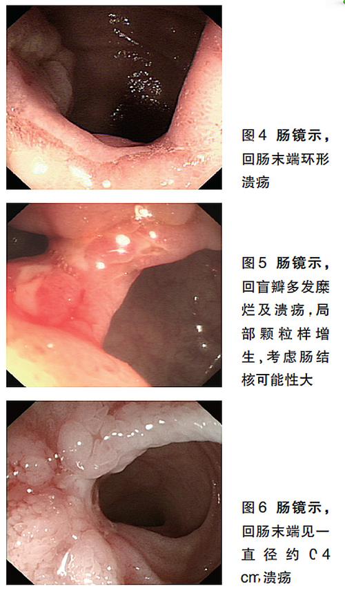 克罗恩病与肠结核鉴别诊断