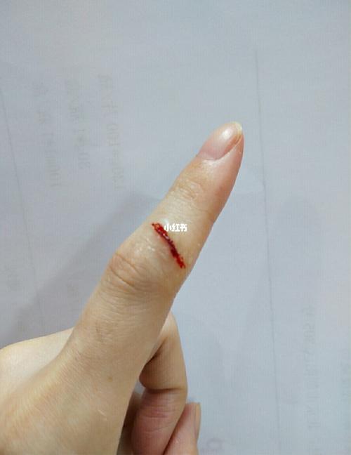 我的手被玻璃划伤了,两个月后还好没留疤_疤痕_祛疤_修复受损_医疗