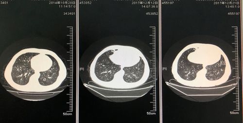 其它 树芽征 写美篇 桶状胸,双肺闻及哮鸣音,左下肺闻及湿啰音. 2017.