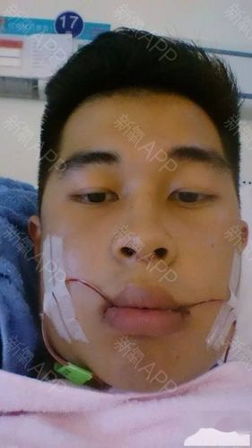 但是没好好带牙套,导致成骨性地包天,10年左右吧,武口正畸科的叶翁