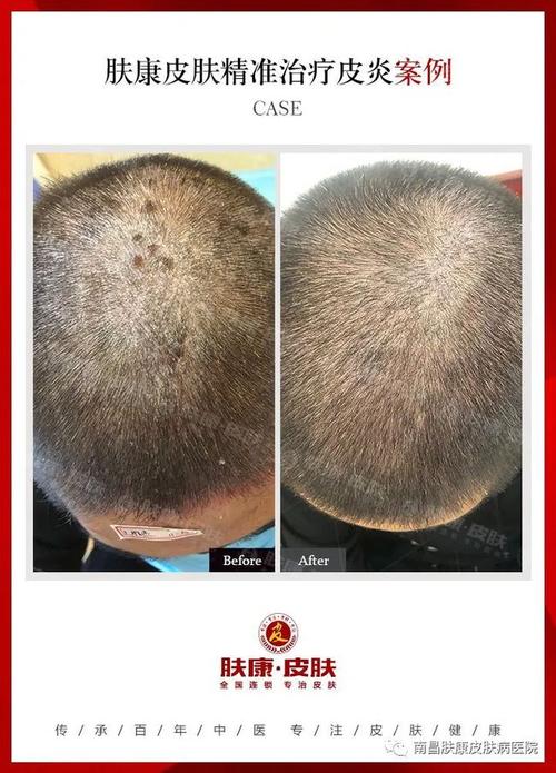 头部皮炎案例图这些因素可能引起头部脂溢性皮炎
