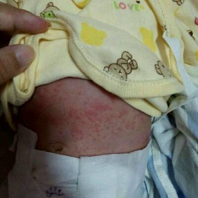 最好是不要外出,现在天气热,可以给宝宝擦一些湿疹膏,我家宝宝