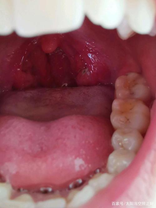 扁桃体术前倒计时第三天