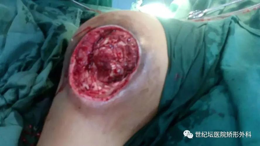 手术的治疗,治疗之后疼痛消失,伤口也痊愈了,以为这样骨髓炎就治疗好