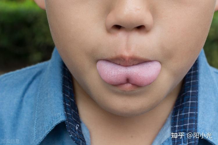 陷阱2:"大舌头"口齿不清,多数和舌系带有关,不如早点给宝宝剪舌系带