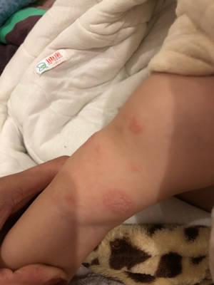 我家宝宝马上10个月了,身上不知道长了什麼,我们已