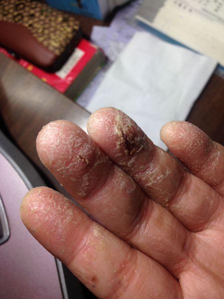 孩子今年9岁,手指干裂脱皮,手背还起一些小疙瘩,往年也有这样的现象