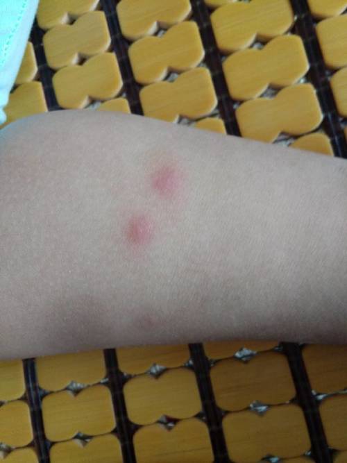 家里两周岁宝宝全身起这种红疙瘩,起起落落,最后成痘印.说是过敏